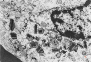 bone marrow - crystalloid inclusions Charcot-Leyden crystals formation